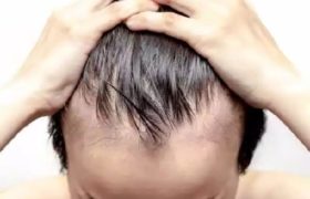 How to treat hair loss.
